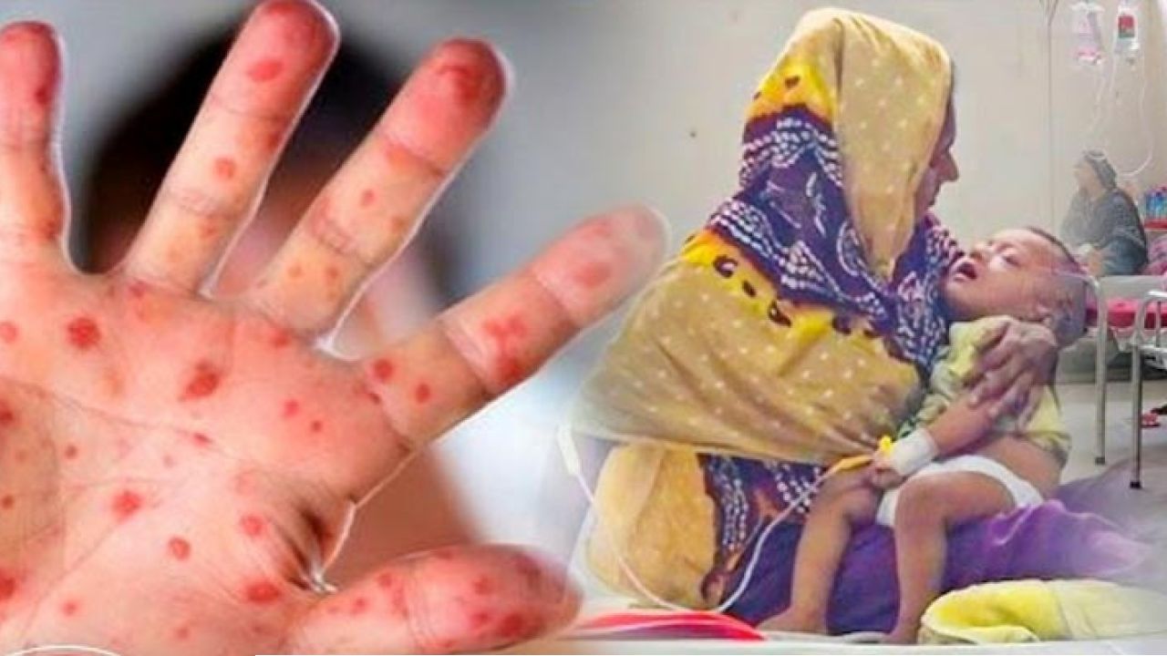 হাম উপসর্গে ৫ জনের মৃত্যু